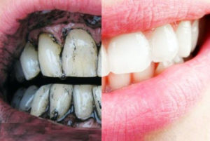 Активированный уголь для зубов вред или польза