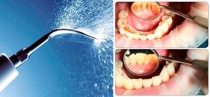 Air flow чистка зубов вред и польза