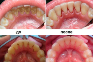 Чистка зубов от камня польза и вред