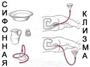 Польза и вред клизмы для очищения кишечника